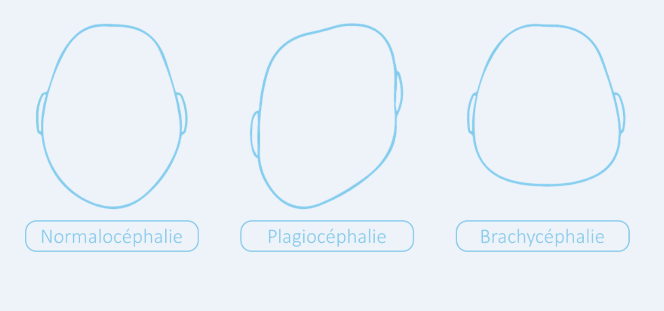 plagiocéphalies